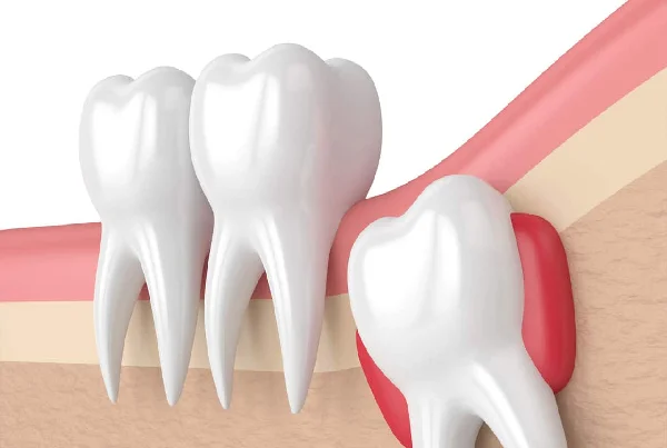 Wisdom Teeth Removal