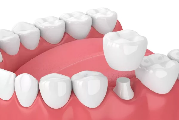 Dental Crown and Bridges